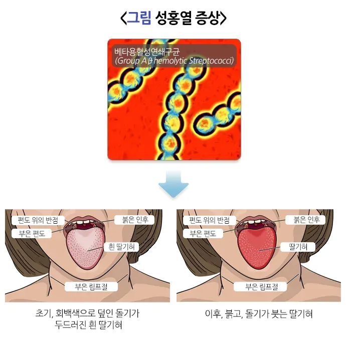 성홍열 증상 설명 이미지 1