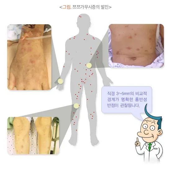 쯔쯔가무시증 증상 설명 이미지 1