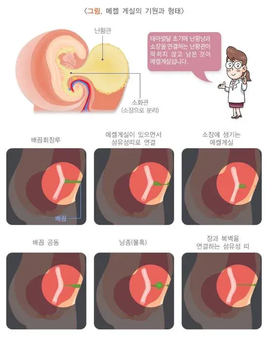 메켈 게실 정의 설명 이미지 1