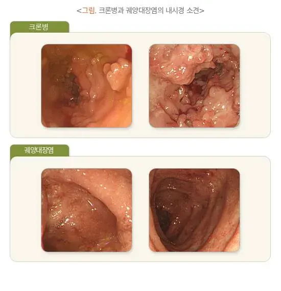 소아 청소년의 혈변 및 흑혈변 원인 설명 이미지 7