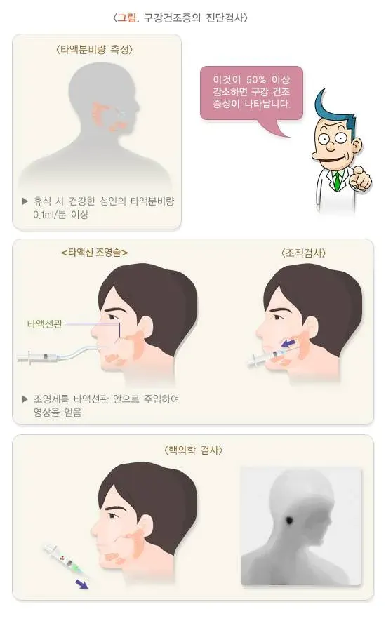 구강건조증 진단 및 검사 설명 이미지 1