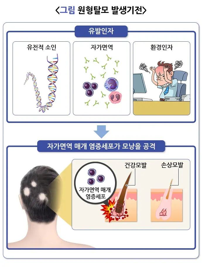 원형탈모 원인 설명 이미지 1