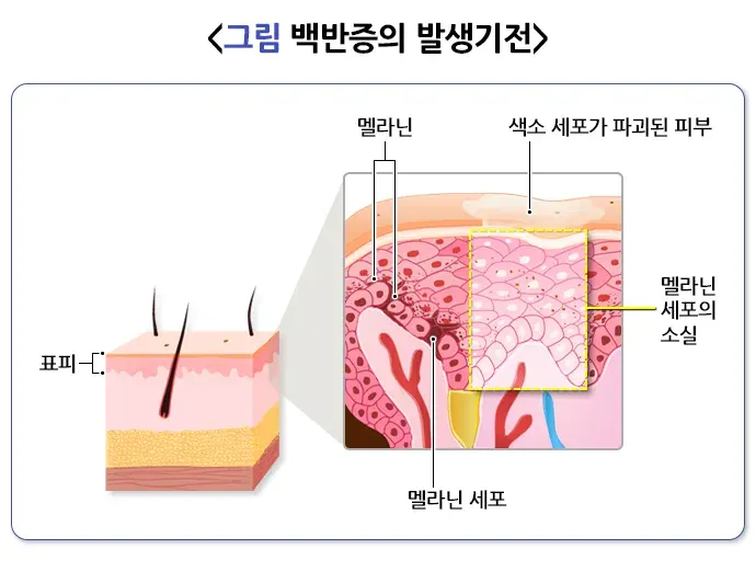 백반증 원인 설명 이미지 1