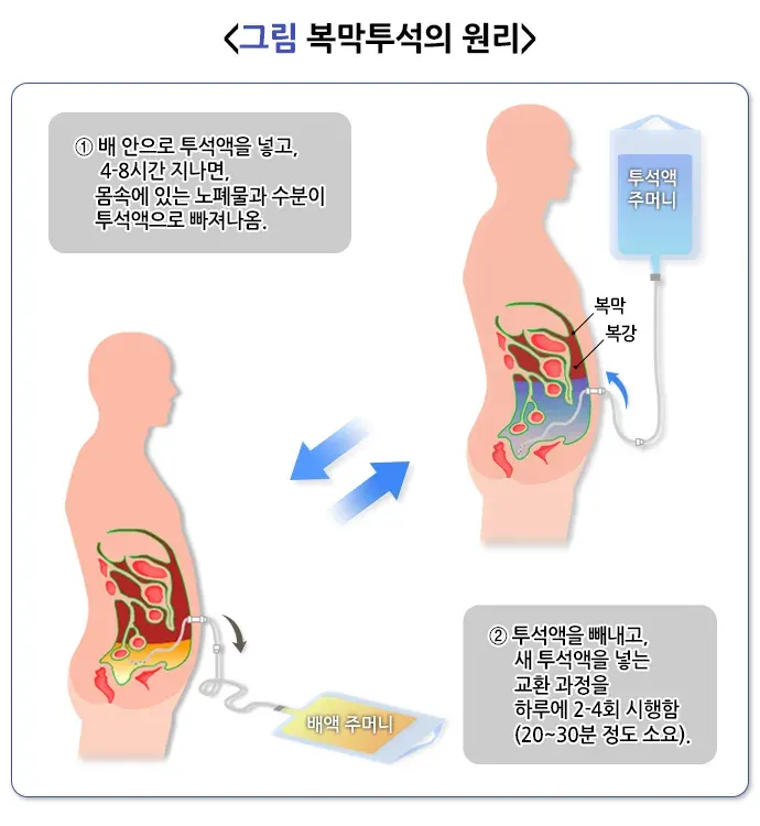 복막투석 치료 방법 설명 이미지 1