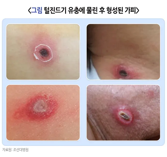 쯔쯔가무시증 증상 설명 이미지 3