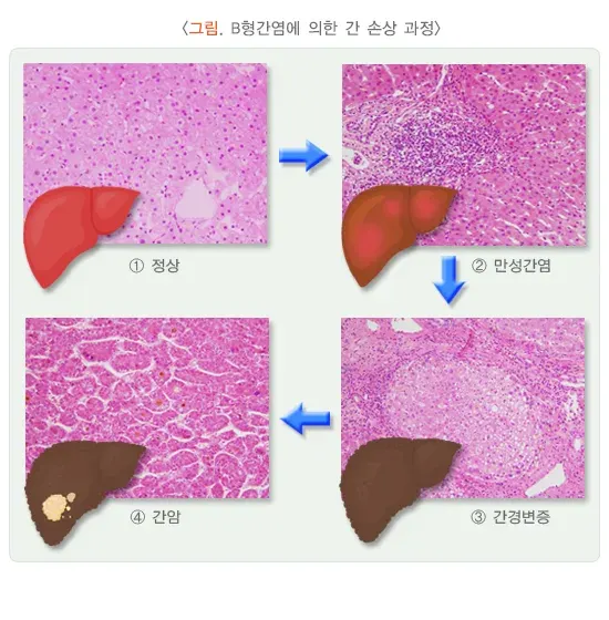 B형간염 합병증 설명 이미지 1