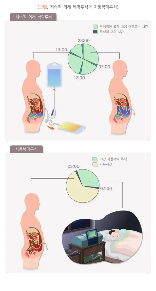 복막투석 치료 방법 설명 이미지 2