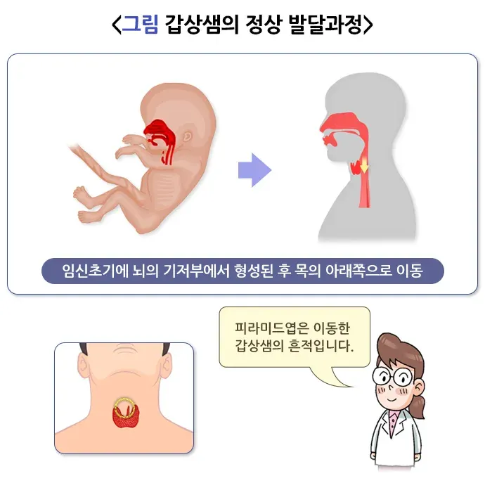 선천갑상샘저하증 원인 설명 이미지 1
