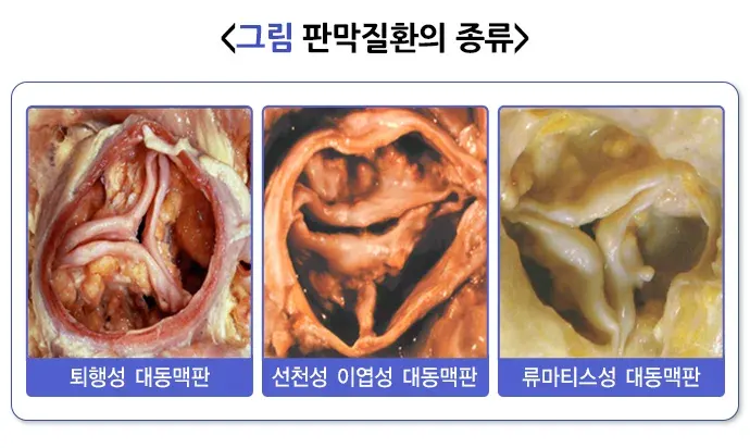 심장 판막 질환 원인 설명 이미지 1