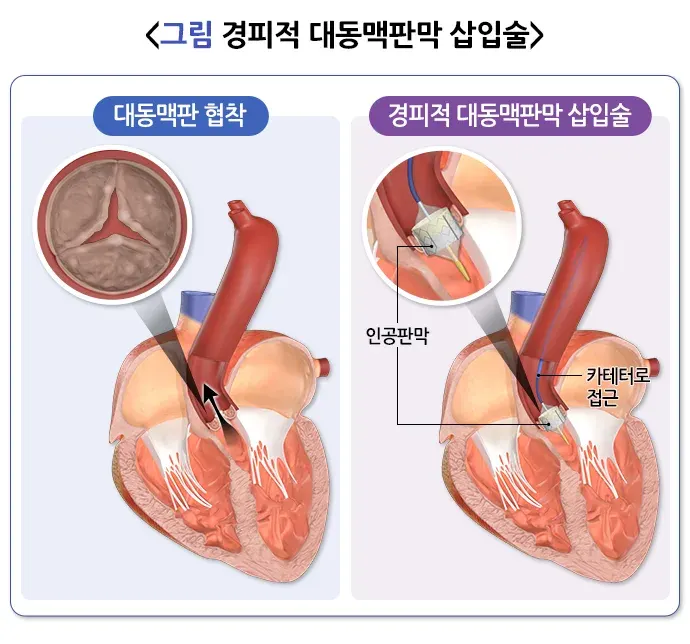 심장 판막 질환 치료 설명 이미지 1
