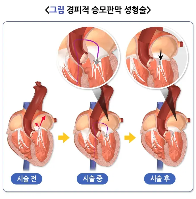 심장 판막 질환 치료 설명 이미지 2