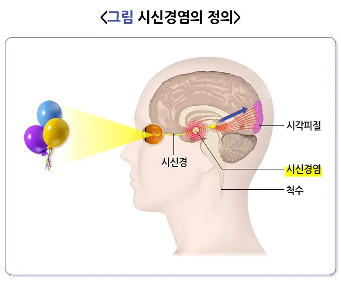 시신경염 정의 설명 이미지 1