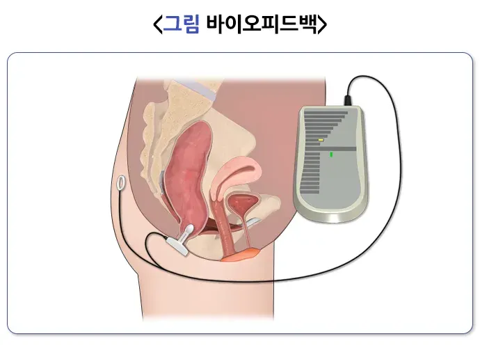 변실금 치료 설명 이미지 1