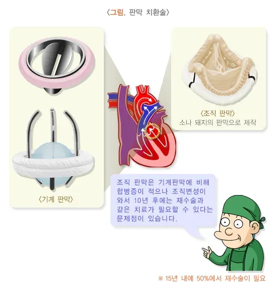 심장 판막 질환 치료 설명 이미지 3