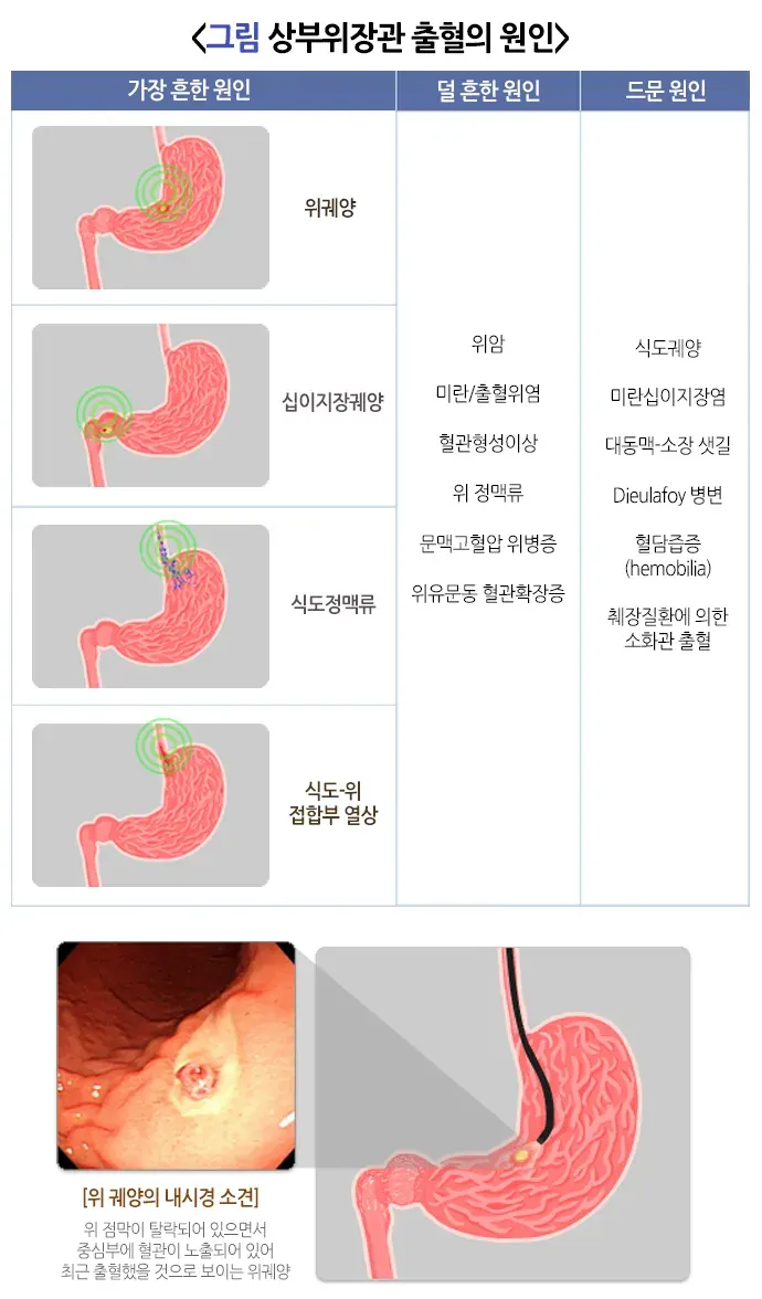 혈변 및 흑변(성인) 원인 설명 이미지 1