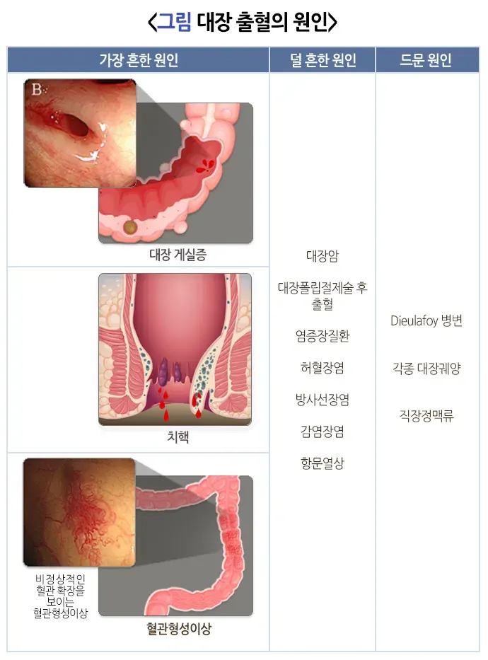 혈변 및 흑변(성인) 원인 설명 이미지 3
