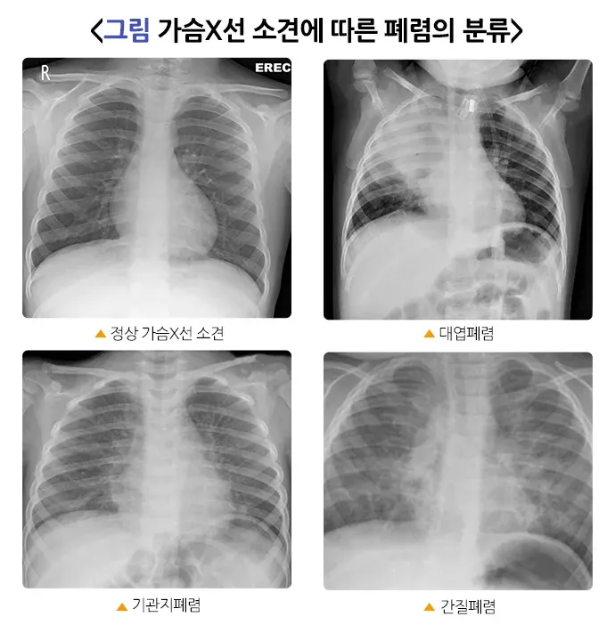 폐렴 종류 설명 이미지 1