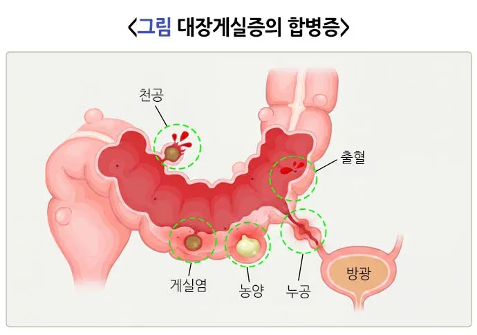 대장게실증 합병증 설명 이미지 1