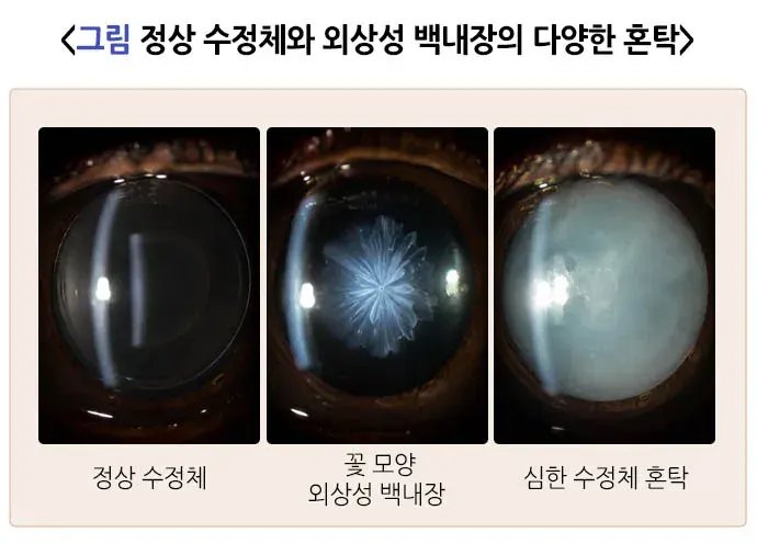 안외상(외상성 백내장 및 수정체 이탈) 치료 설명 이미지 1
