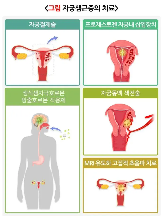 자궁샘근증 치료 설명 이미지 1
