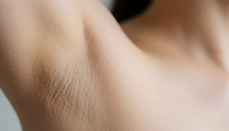 모낭과 땀샘 부위에 생긴 염증성 좁쌀 병변의 클로즈업