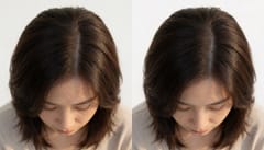 의정부 모발이식병원, 가르마 폭이 넓어지는 계절이라면