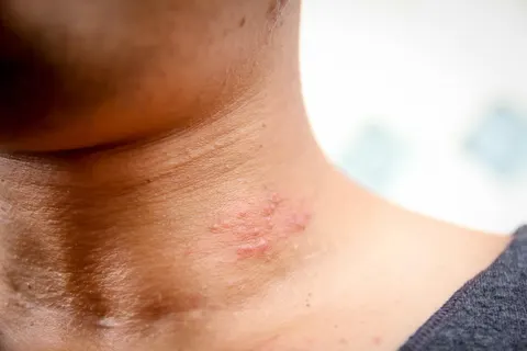 바늘로 찌르는 듯한 통증, 대상포진의 시작일 수 있다