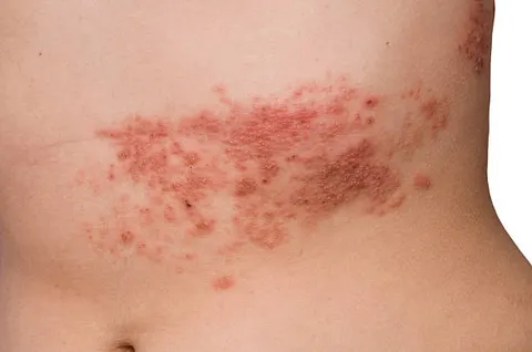 띠 모양 발진과 극심한 통증 대상포진 조기 치료가 관건