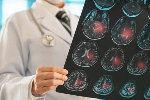 PCSK9 억제제 ‘에볼로쿠맙’, 심근경색·뇌졸중 병력 없는 환자에서도 심혈관 사건 위험 25% 감소