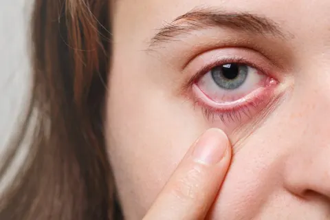 하루 10시간 스마트폰에 눈 혹사”… 디지털 피로가 부른 안구건조증 주의보