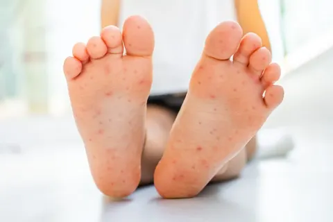 무좀인 줄 알았던 간지러움 계속 긁어도 낫지 않는 발, 오진이 증상 키운다