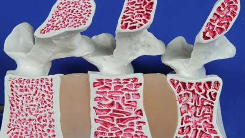 조용히 뼈를 갉아먹는 ‘골다공증’… 갱년기 여성, 침묵의 질병 주의보