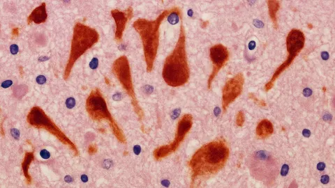 수면제로 알츠하이머 예방? ‘렘보렉산트’, 뇌 신경세포 보호 가능성 제시