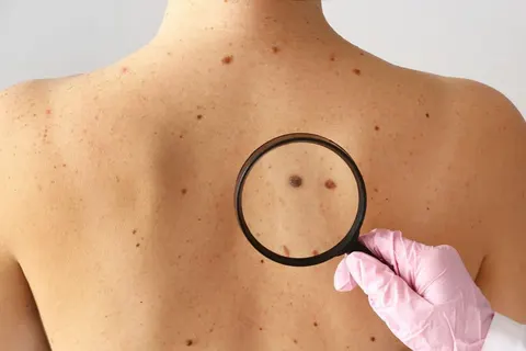 점인 줄 알았는데 피부암? 초기 신호 놓치기 쉬운 이유