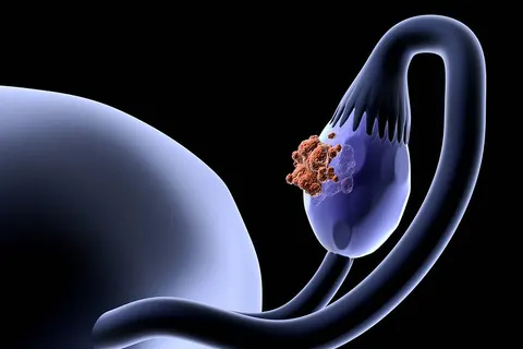 조용히 퍼지는 침묵의 암… 난소암은 왜 조기 발견이 어려울까?