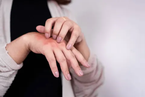 NIH “스테로이드 중단 후 피부염, 아토피와 전혀 다른 질환”… 비타민B3 대사 이상이 원인