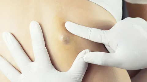 피지낭종, 방치하면 감염 위험! 작다고 무시하면 큰일 난다