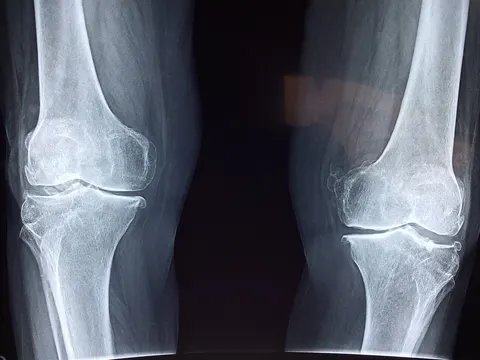 암의 뼈 전이 막는 단서 찾았다…ACBP 단백질이 새로운 치료 표적